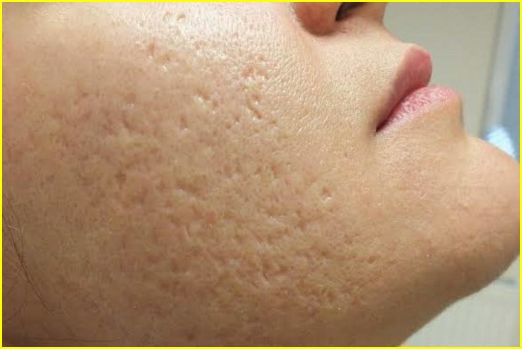 side effects of multani mitti on oily skin